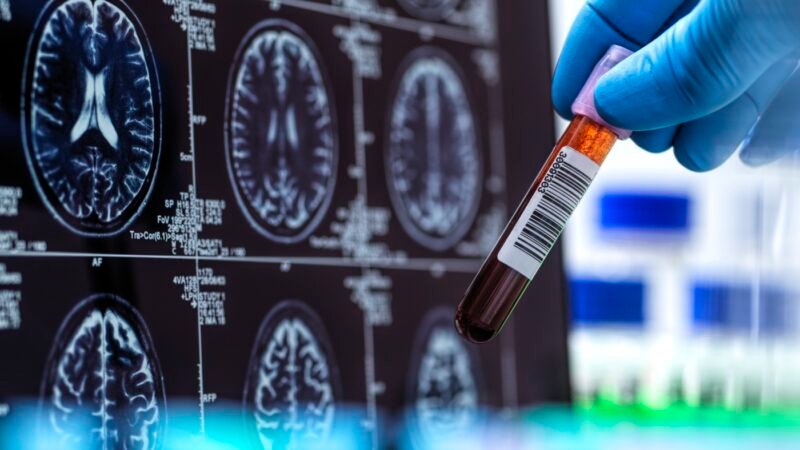 Alzheimer’s Breakthrough: First FDA-Cleared Blood Test Enhances Diagnosis Speed and Accuracy